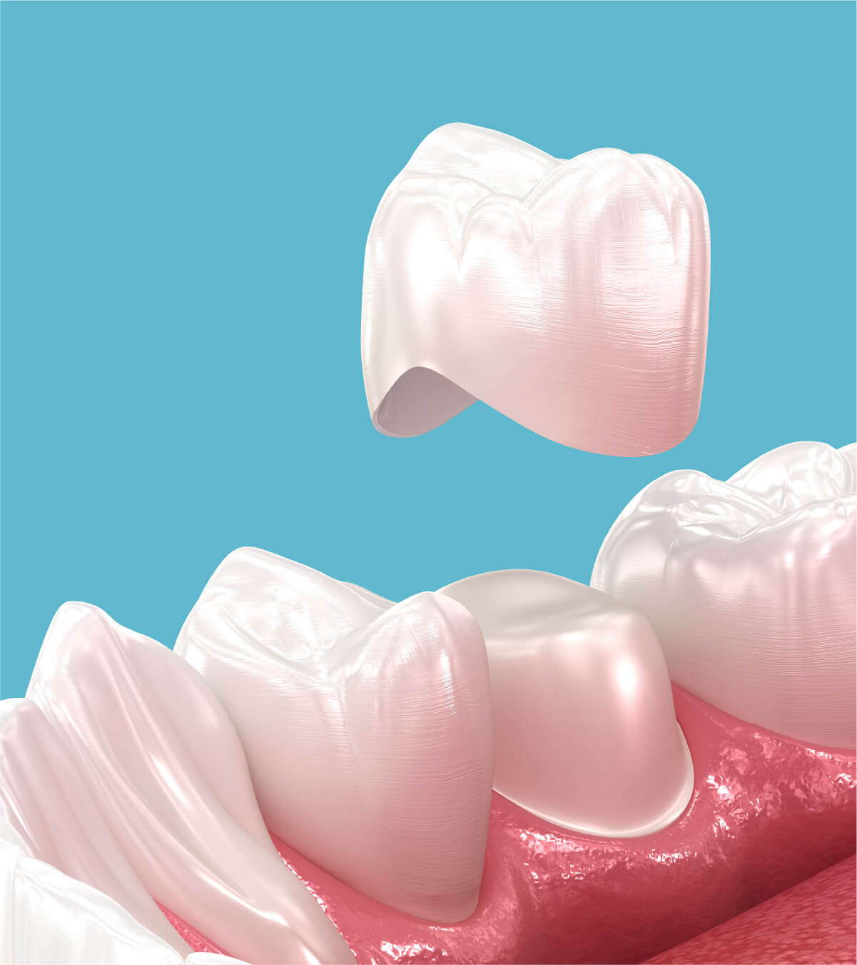 What Are Dental Crowns?